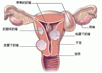 妇科医院宫腹腔镜微创手术——切除巨型肌瘤