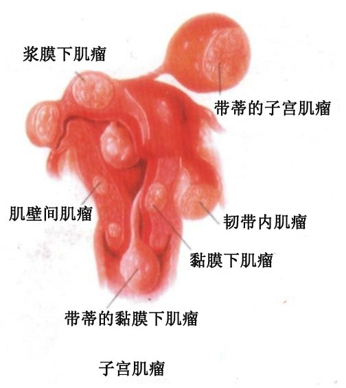 四大病变让女人患上了子宫肌瘤