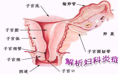 霉菌性阴道炎怎么根治
